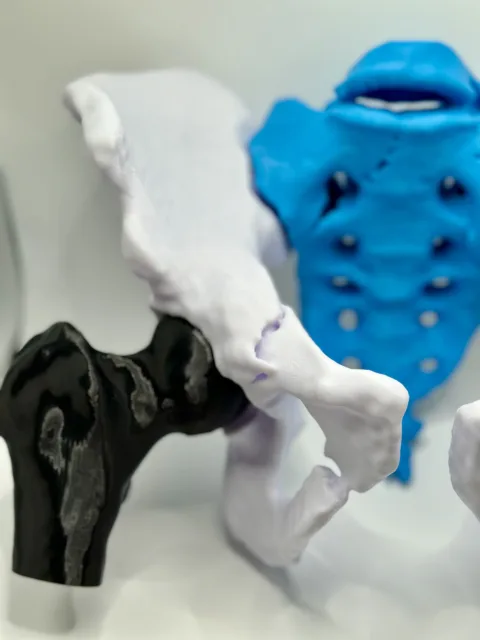 Multiple Beckenfrakturen 3D Druckdatei