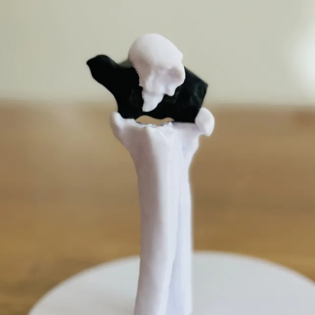 Olecanon Fraktur 3D Modell